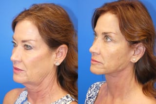 Before and after Facelift case 43132 - Angle 4
