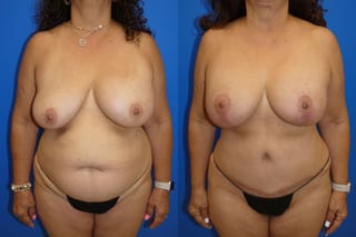 Before and after Mommy Makeover case 43720 - Angle 1
