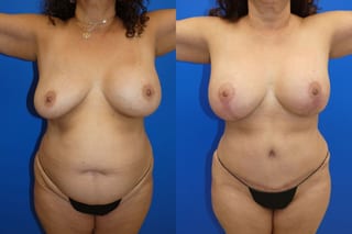 Before and after Mommy Makeover case 43720 - Angle 2