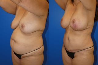 Before and after Mommy Makeover case 43720 - Angle 4