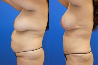 Before and after Mommy Makeover case 43720 - Angle 5