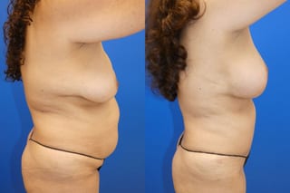 Before and after Mommy Makeover case 43720 - Angle 6