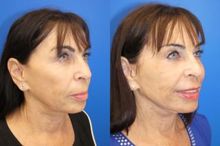 Before and after Facelift case 24015 - Angle 2