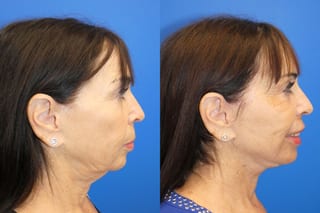 Before and after Facelift case 24015 - Angle 3