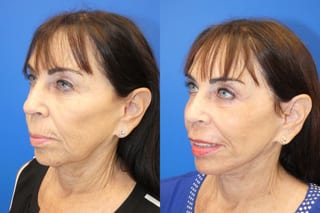 Before and after Facelift case 24015 - Angle 4