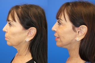 Before and after Facelift case 24015 - Angle 5