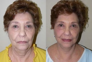 Before and after Facelift case 24070 - Angle 1