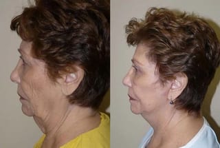 Before and after Facelift case 24070 - Angle 2