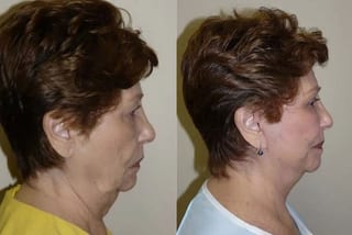 Before and after Facelift case 24070 - Angle 3