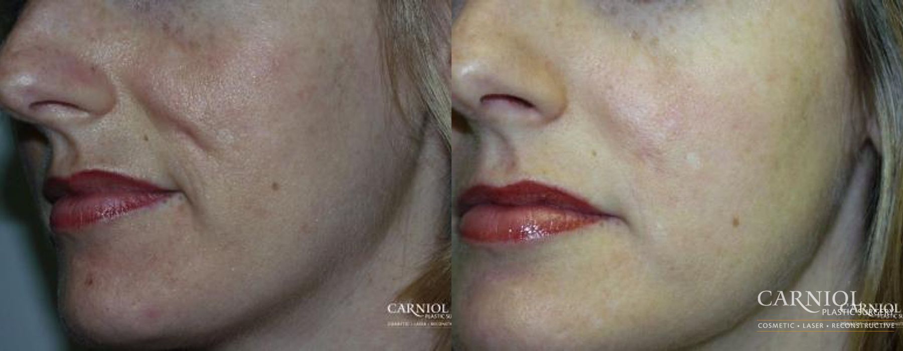 Acne Rejuvenation - Case 2699