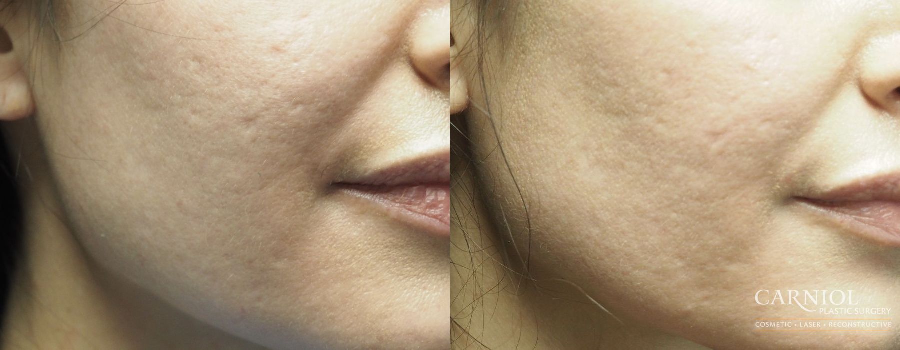 Before and after Acne Scars case 7763