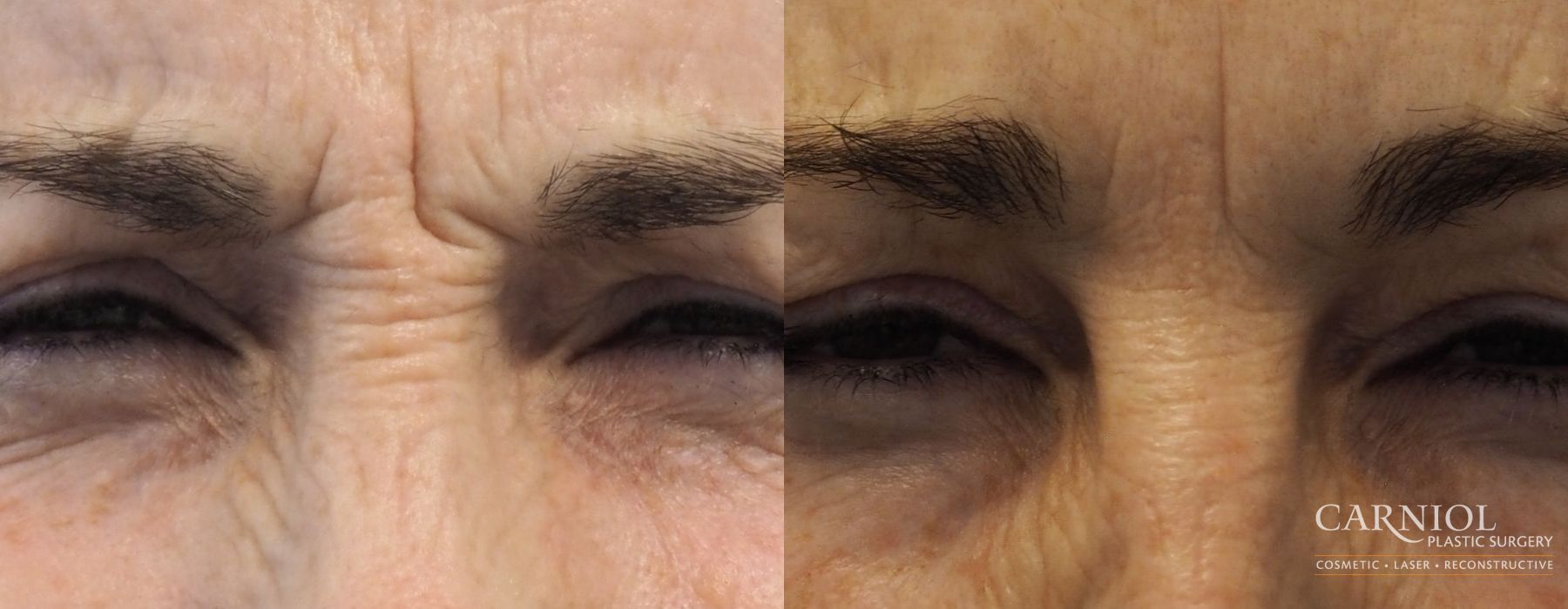 Before and after BOTOX® Cosmetic case 7752 - Angle 3