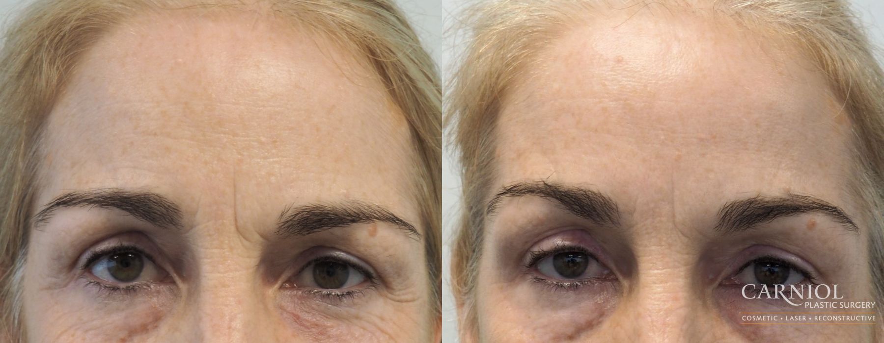 Before and after BOTOX® Cosmetic case 7752