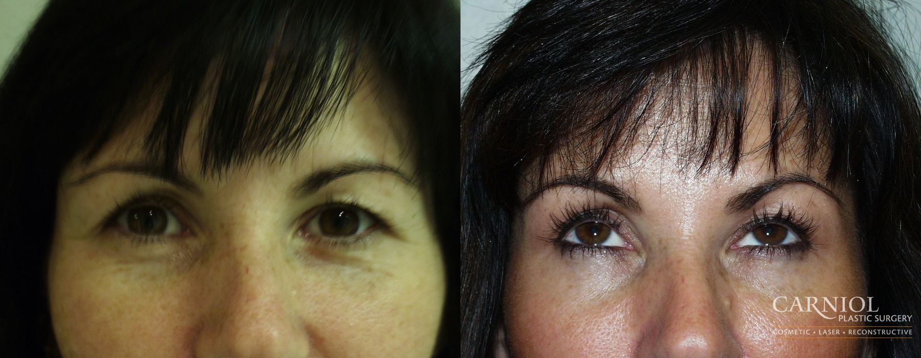BOTOX® Cosmetic - Case 2783