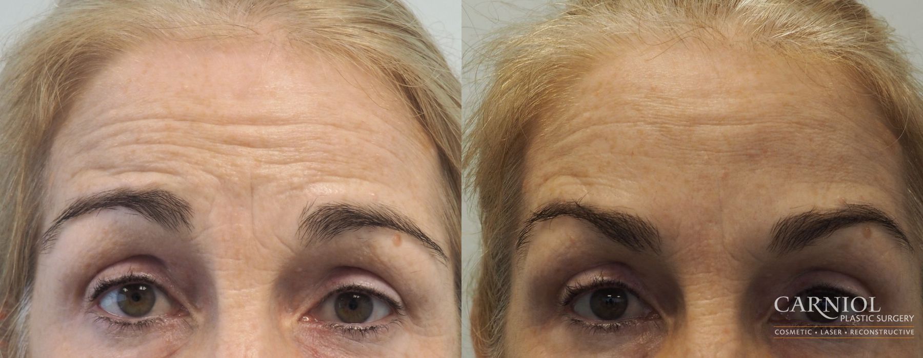 Before and after BOTOX® Cosmetic case 7752 - Angle 2