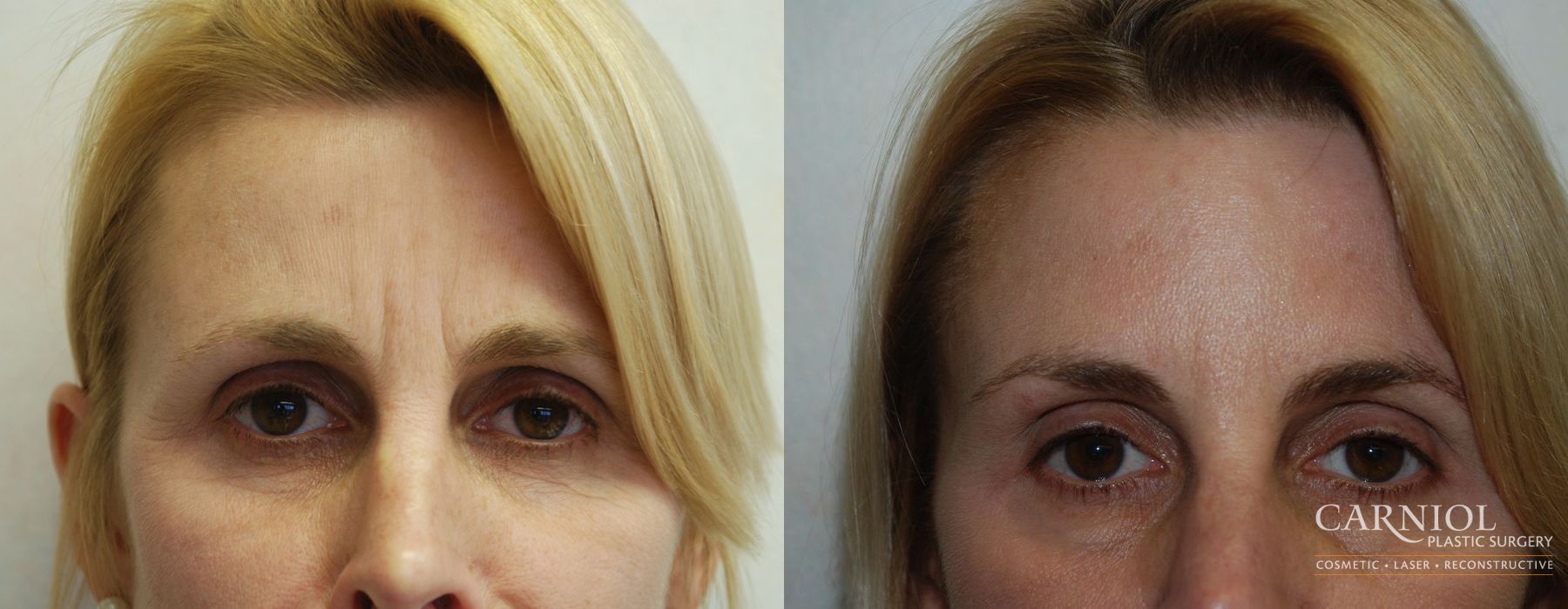Before and after BOTOX® Cosmetic case 7679