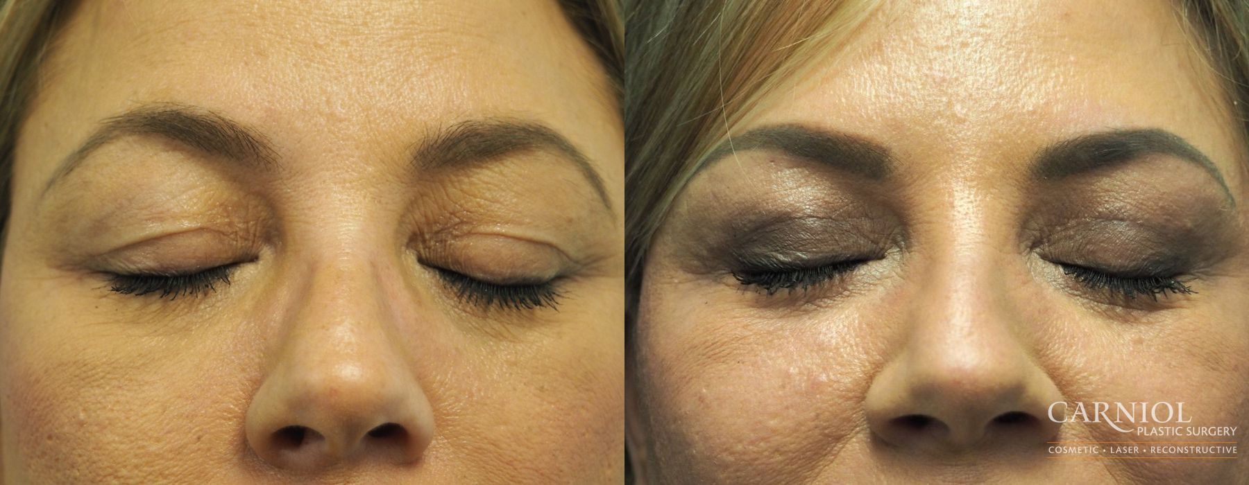 Blepharoplasty - Thumbnail 2