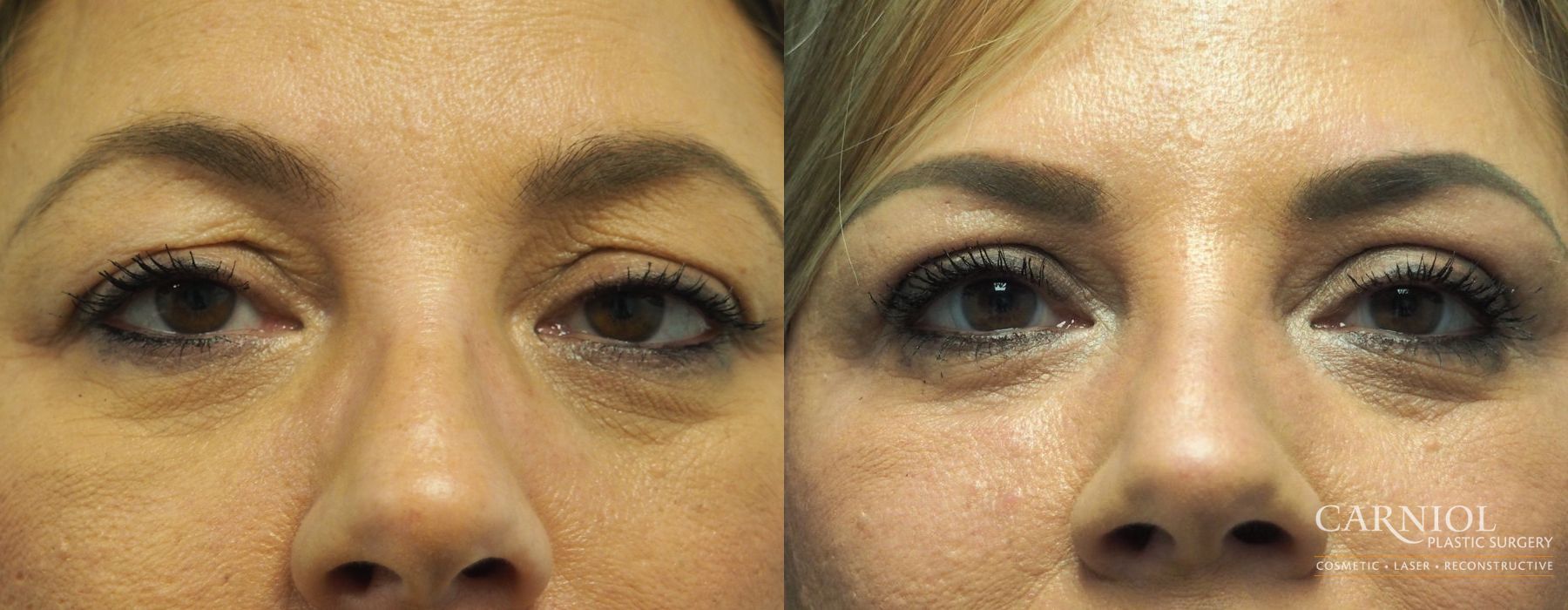 Blepharoplasty - Case 2706