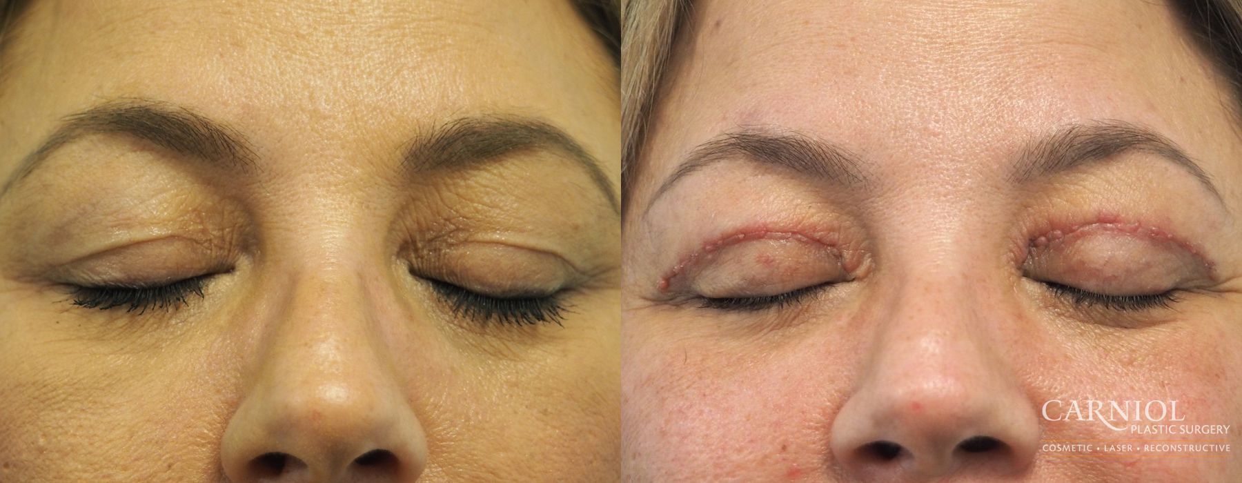 Blepharoplasty - Thumbnail 2