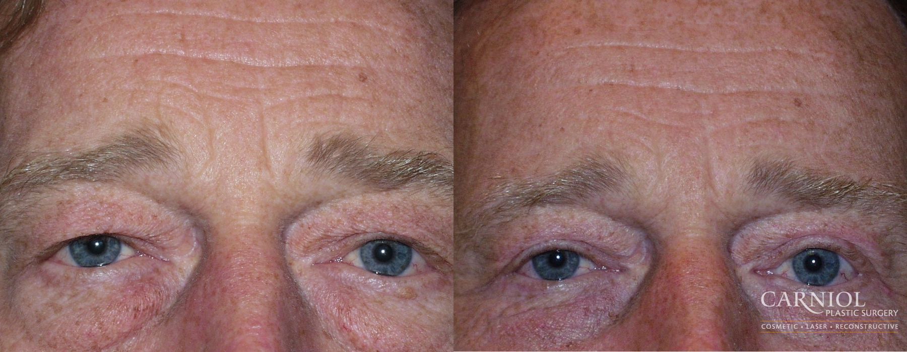 Blepharoplasty - Case 2703