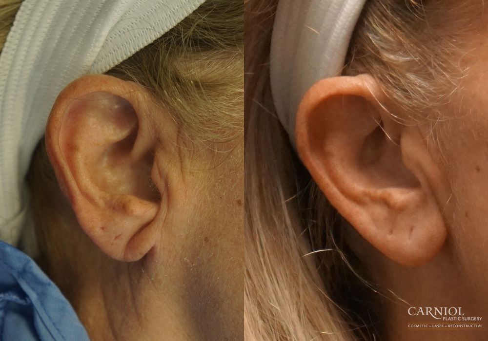 Before and after Earlobe Surgery case 7771