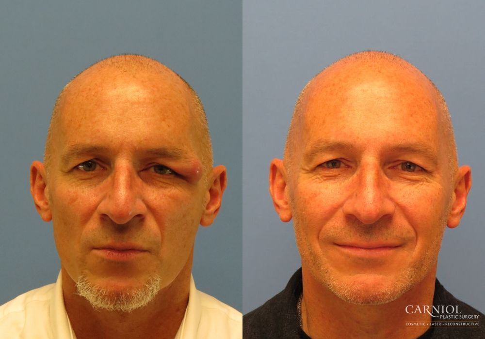 Eyelid Surgery - Case 2711