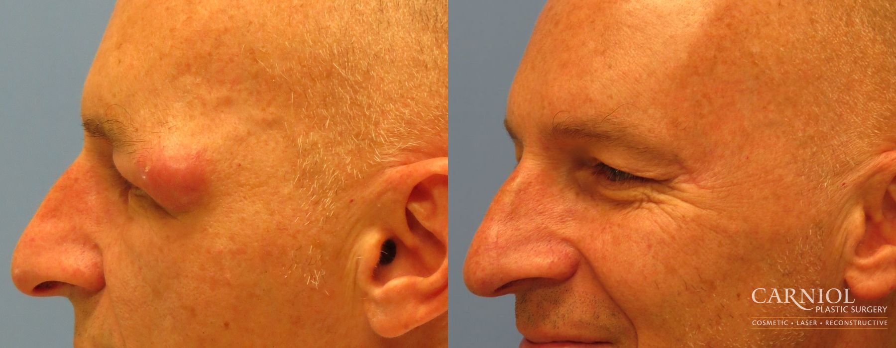 Eyelid Surgery - Thumbnail 3