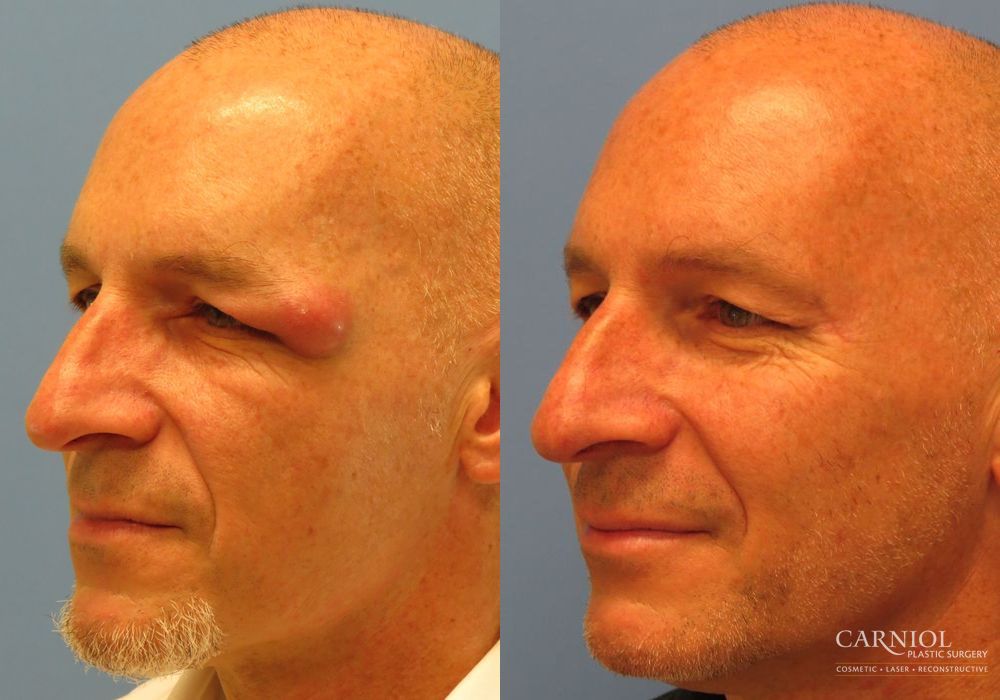 Eyelid Surgery - Thumbnail 2