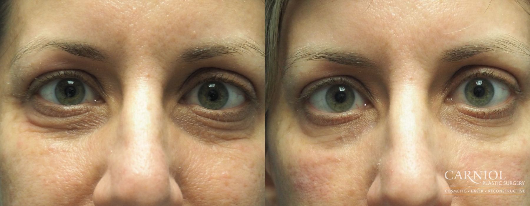 Before and after Facial Rejuvenation case 7784