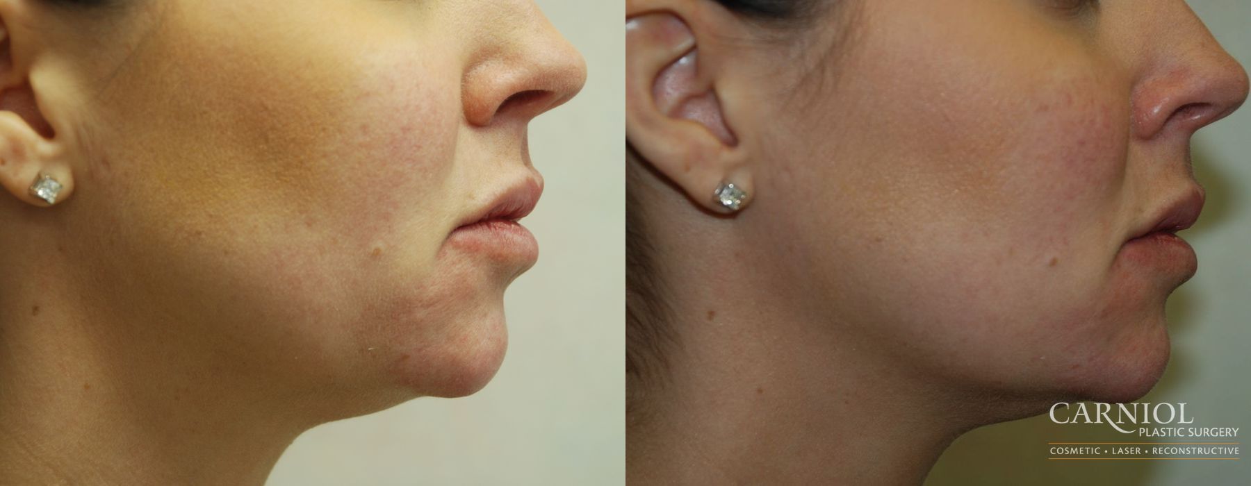 Before and after Facial Tightening case 7722