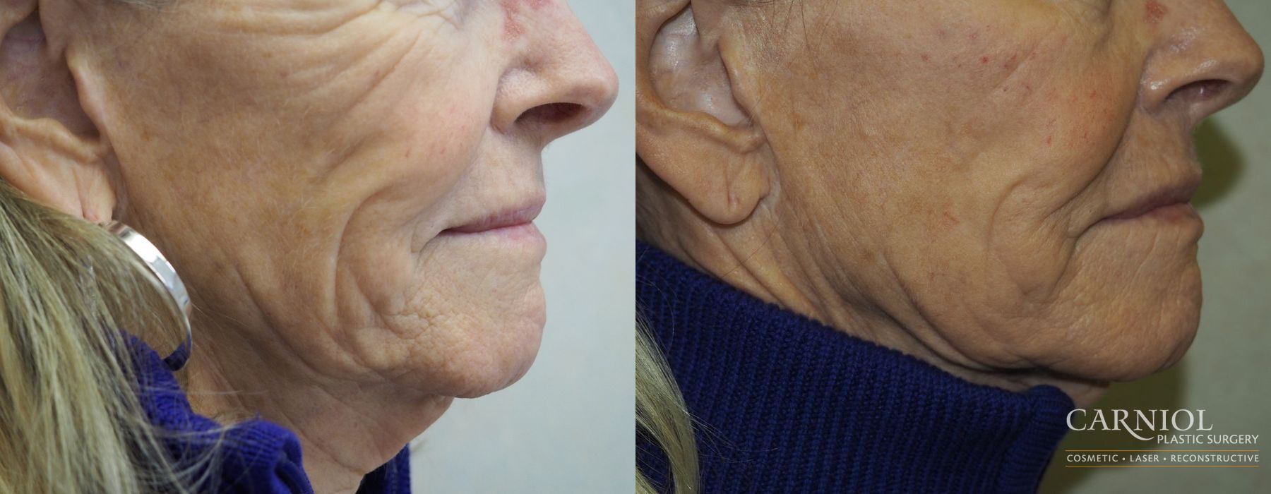 Before and after Facial Tightening case 7726