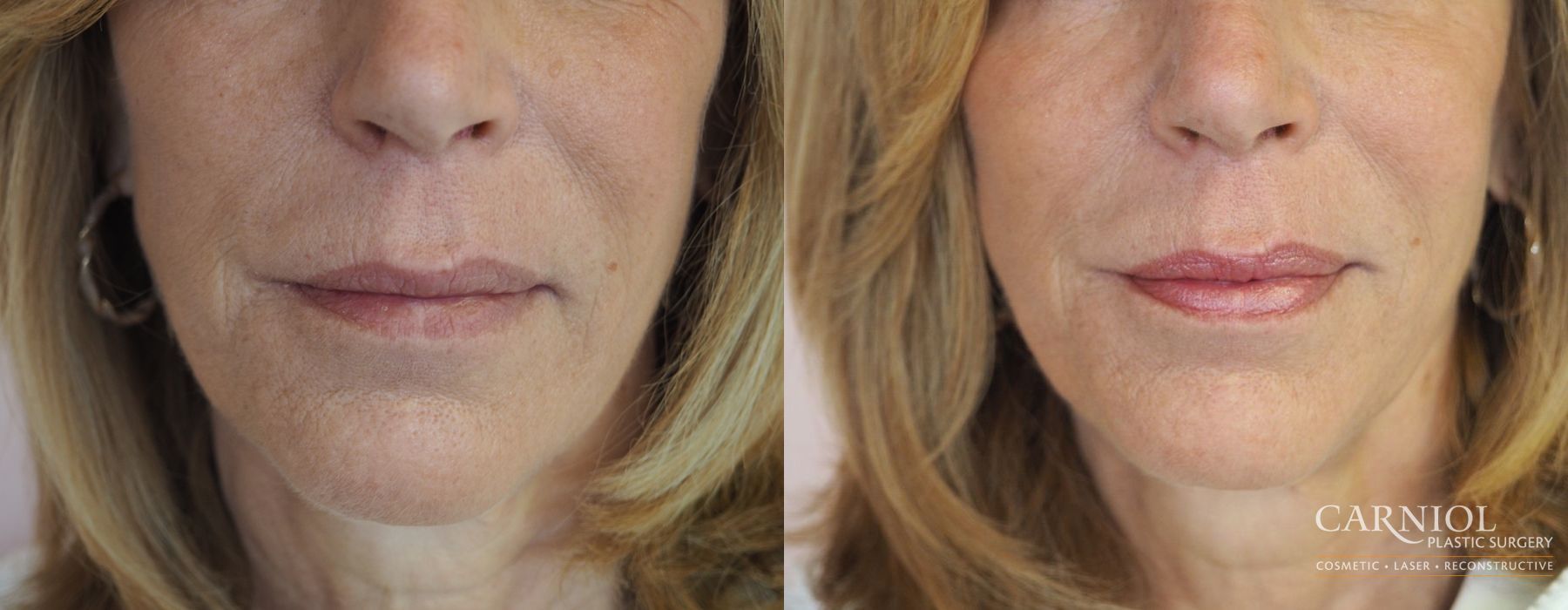 Before and after Fillers case 7714