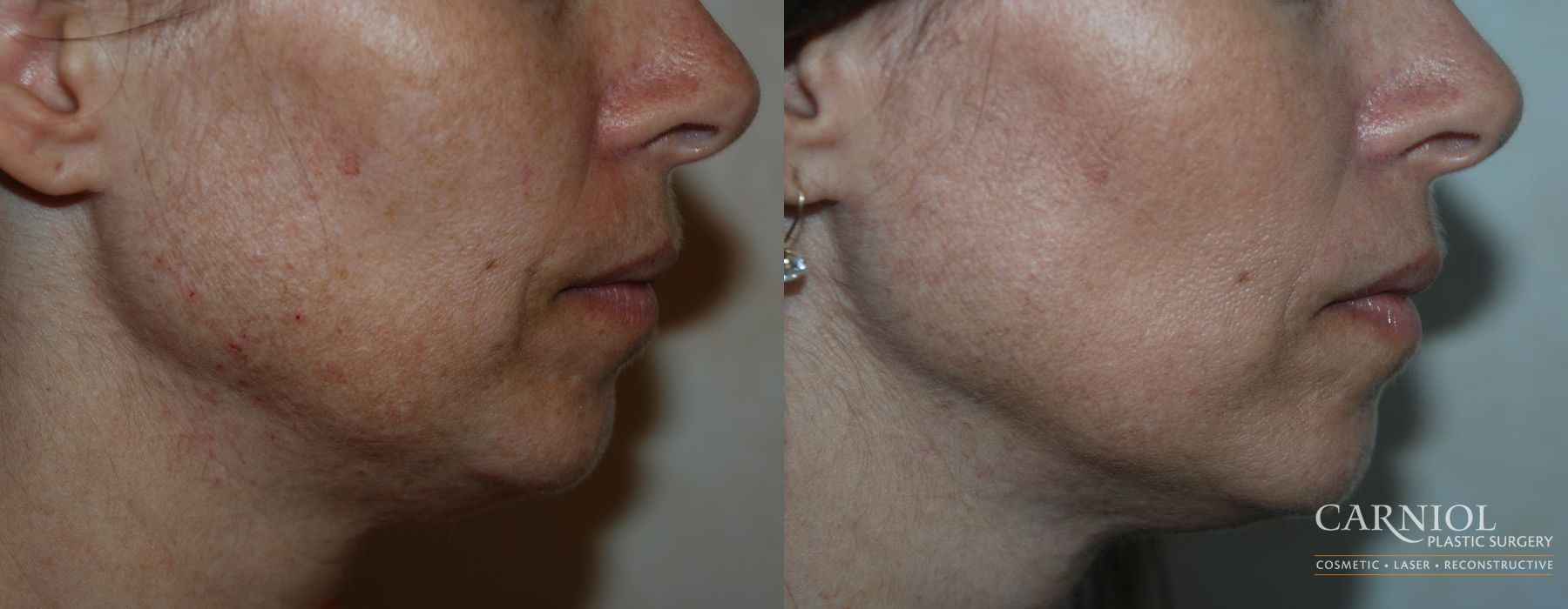 Before and after Fractional Resurfacing case 7681