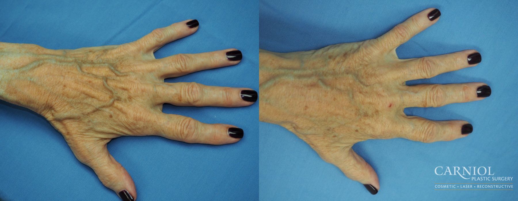 Hand Rejuvenation - Case 2803