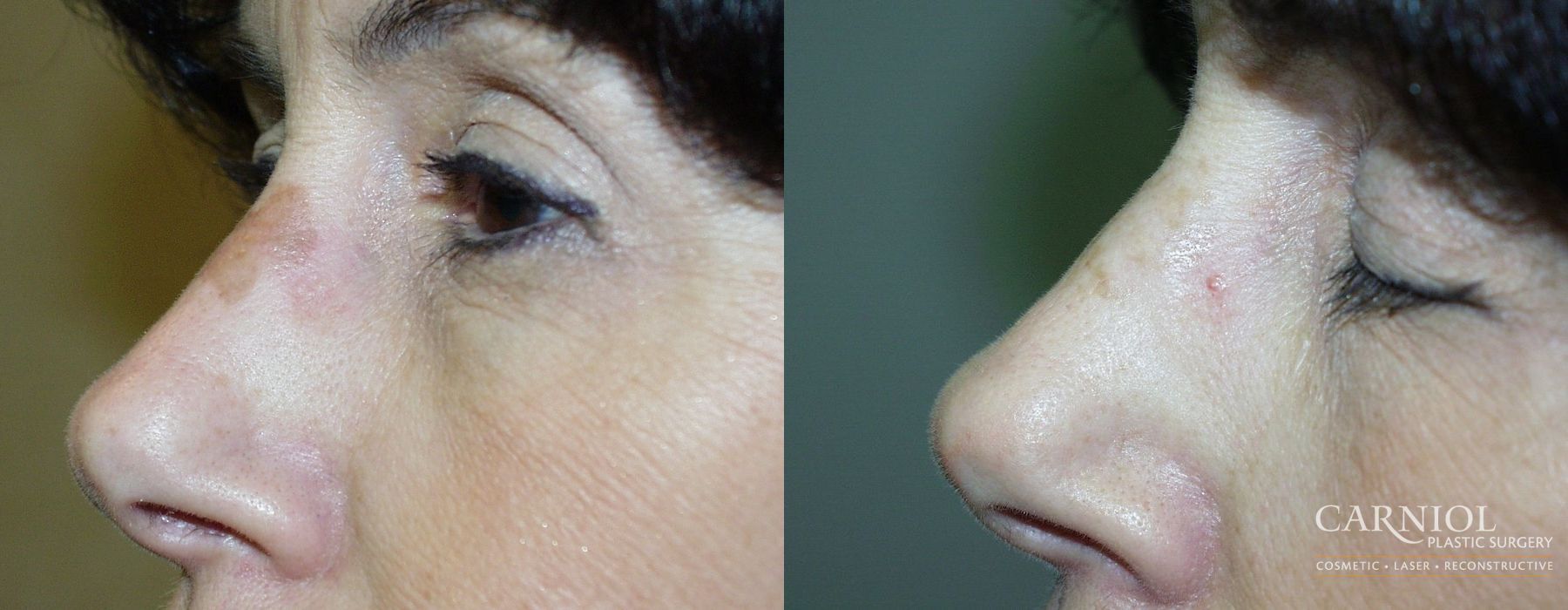 Laser Skin Resurfacing - Face - Case 2723