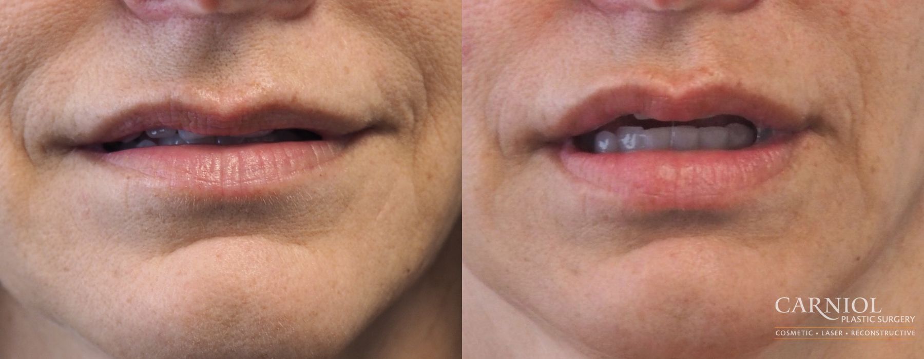 Lip Augmentation - Case 2731