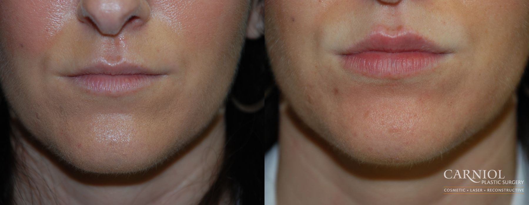 Before and after Lip Augmentation case 7655