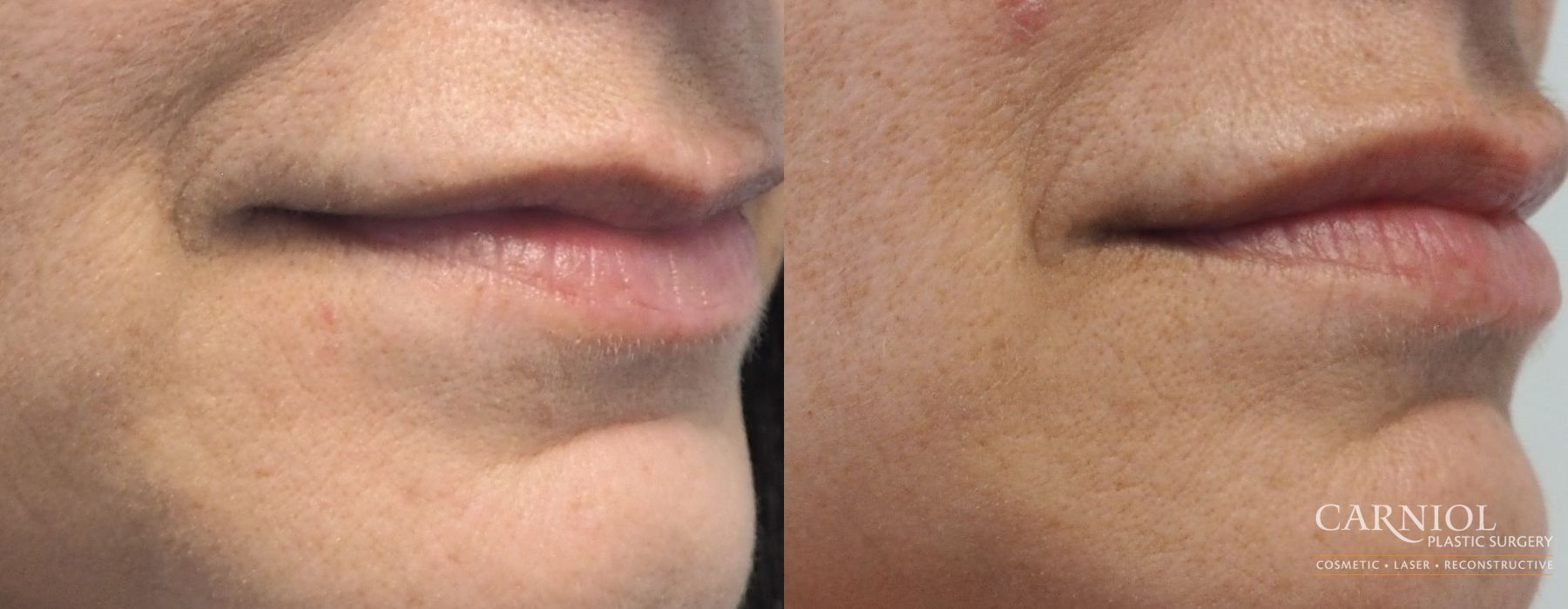 Lip Augmentation - Thumbnail 2