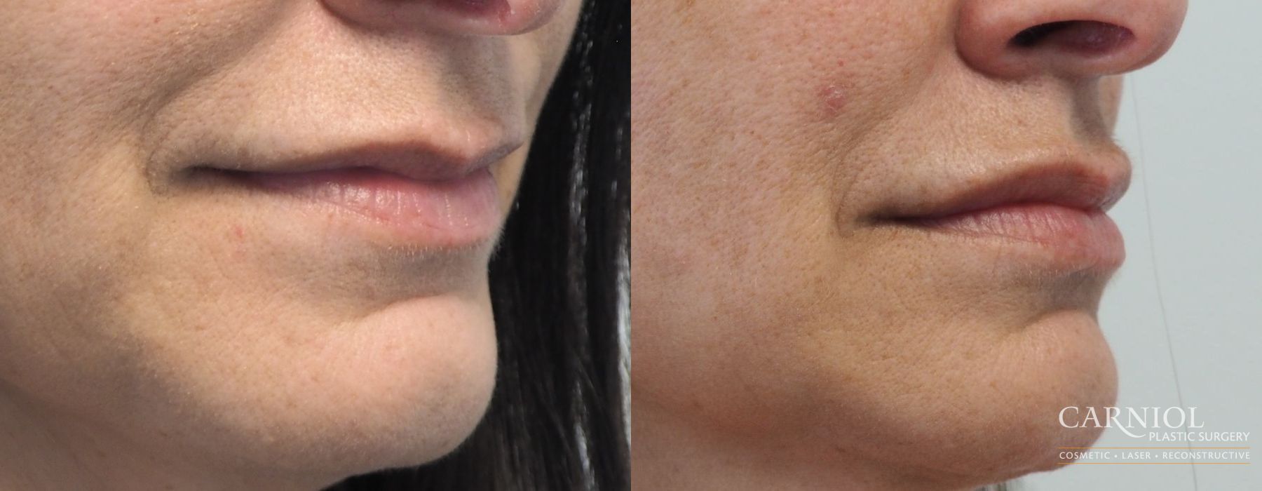 Lip Augmentation - Thumbnail 2