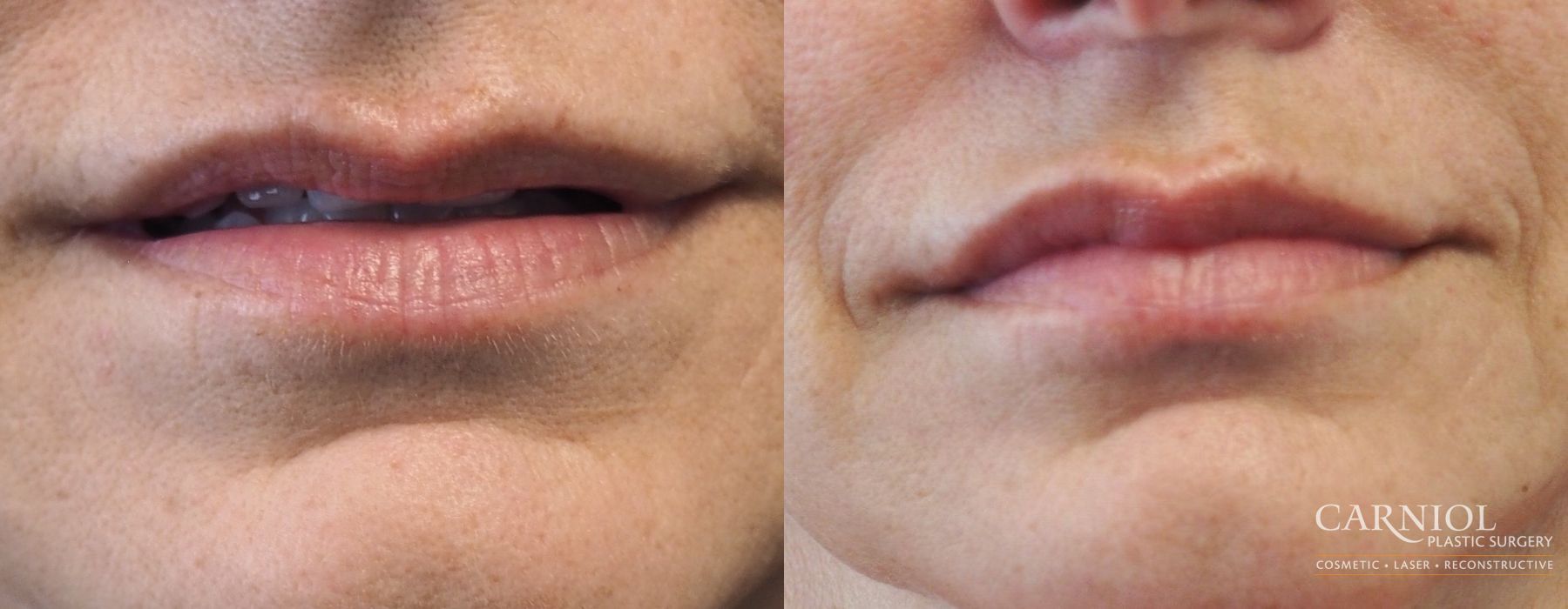 Lip Augmentation - Case 2732
