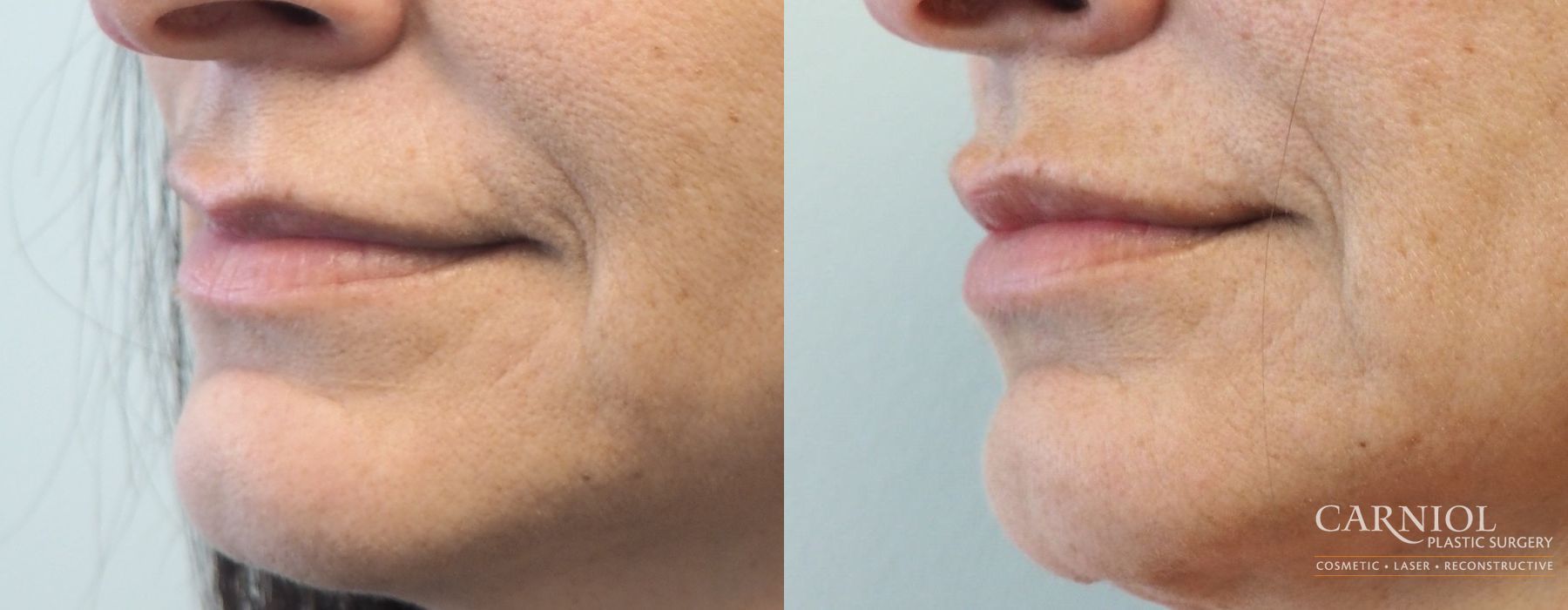 Lip Augmentation - Thumbnail 3