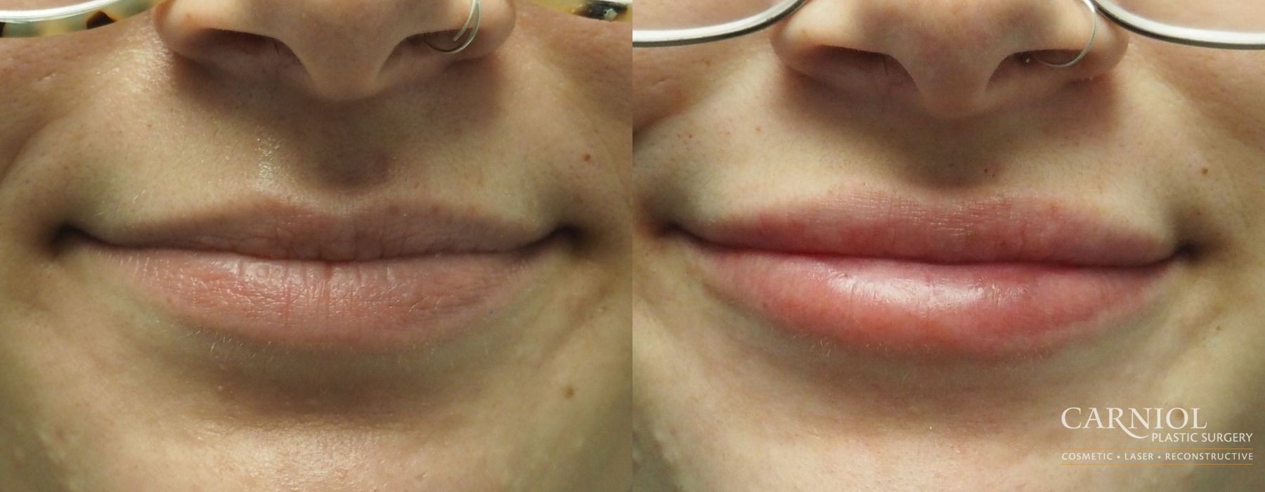 Lip Filler - Case 2734