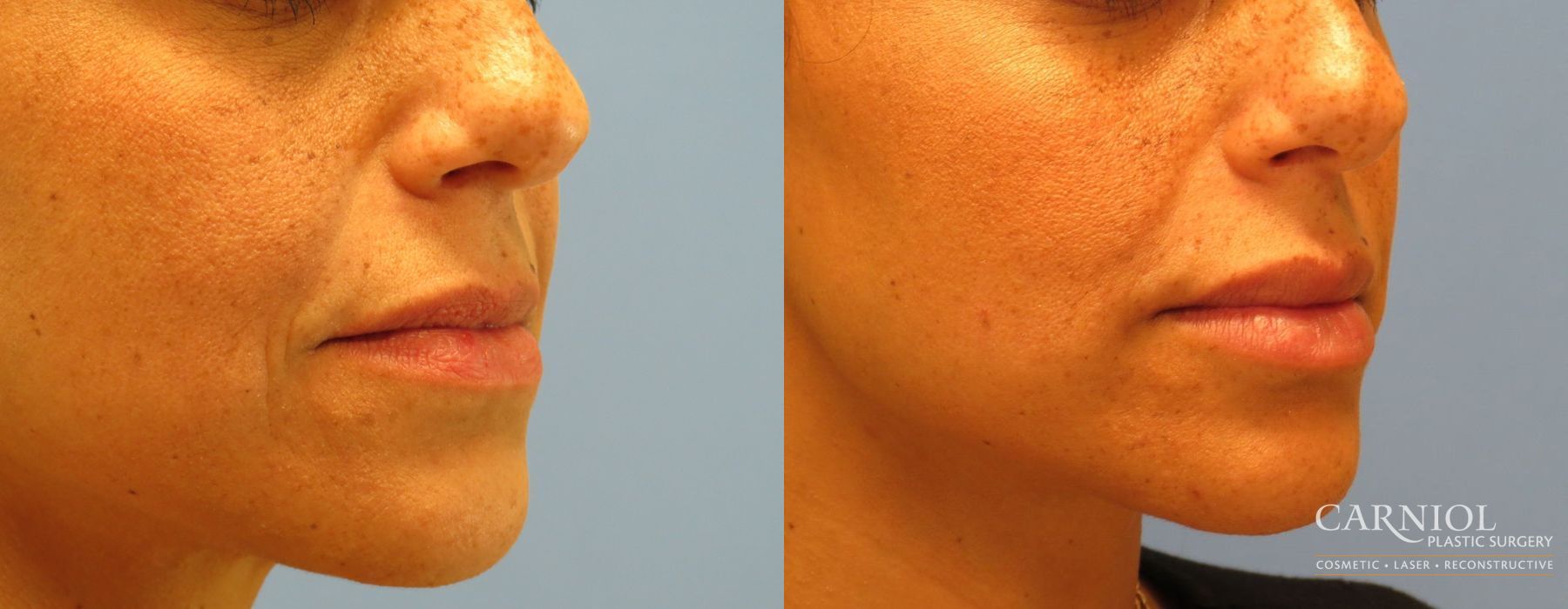 Lip Filler - Thumbnail 3