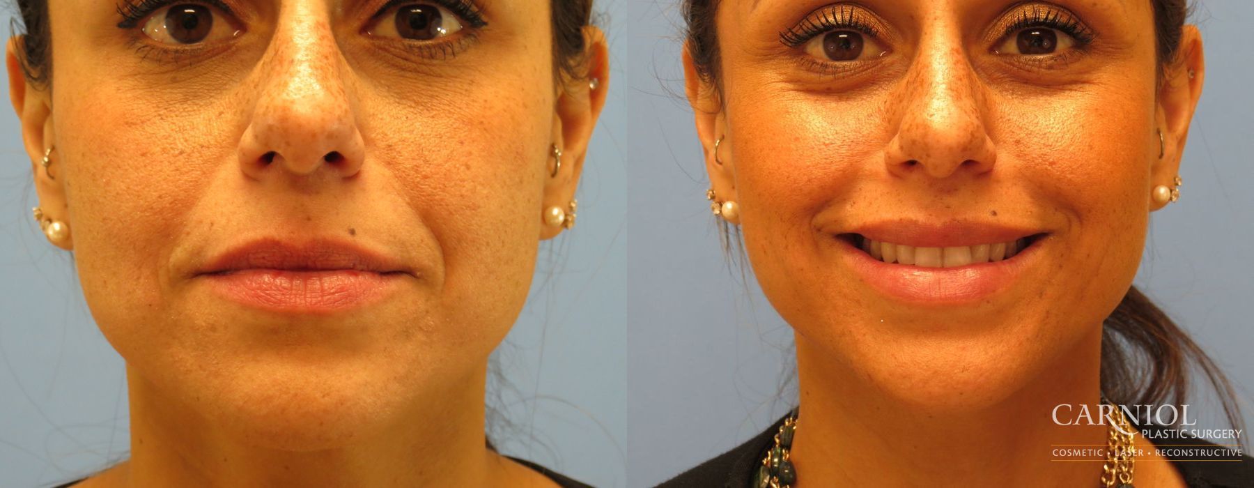 Lip Filler - Thumbnail 4