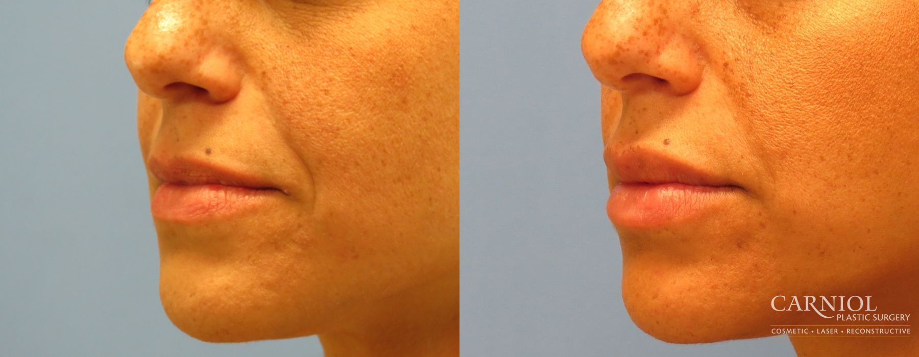 Lip Filler - Thumbnail 2