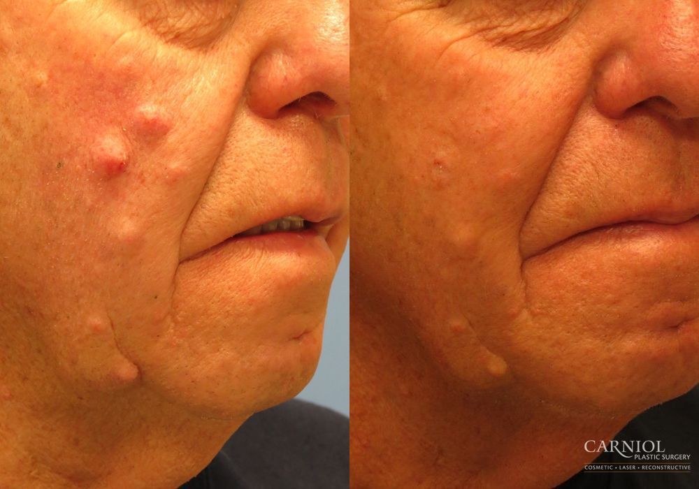 Before and after Mole or Age Spot Removal case 7772 - Angle 2