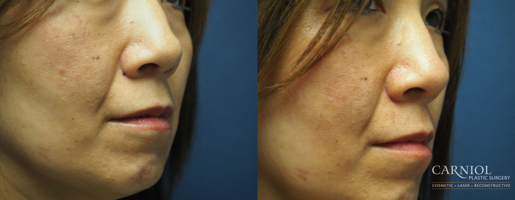 Mole or Age Spot Removal - Case 2811