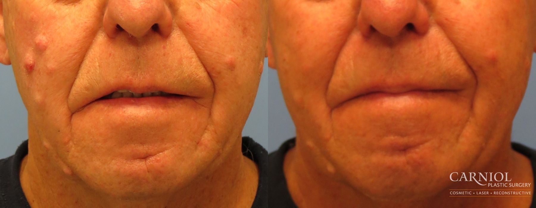 Before and after Mole or Age Spot Removal case 7772