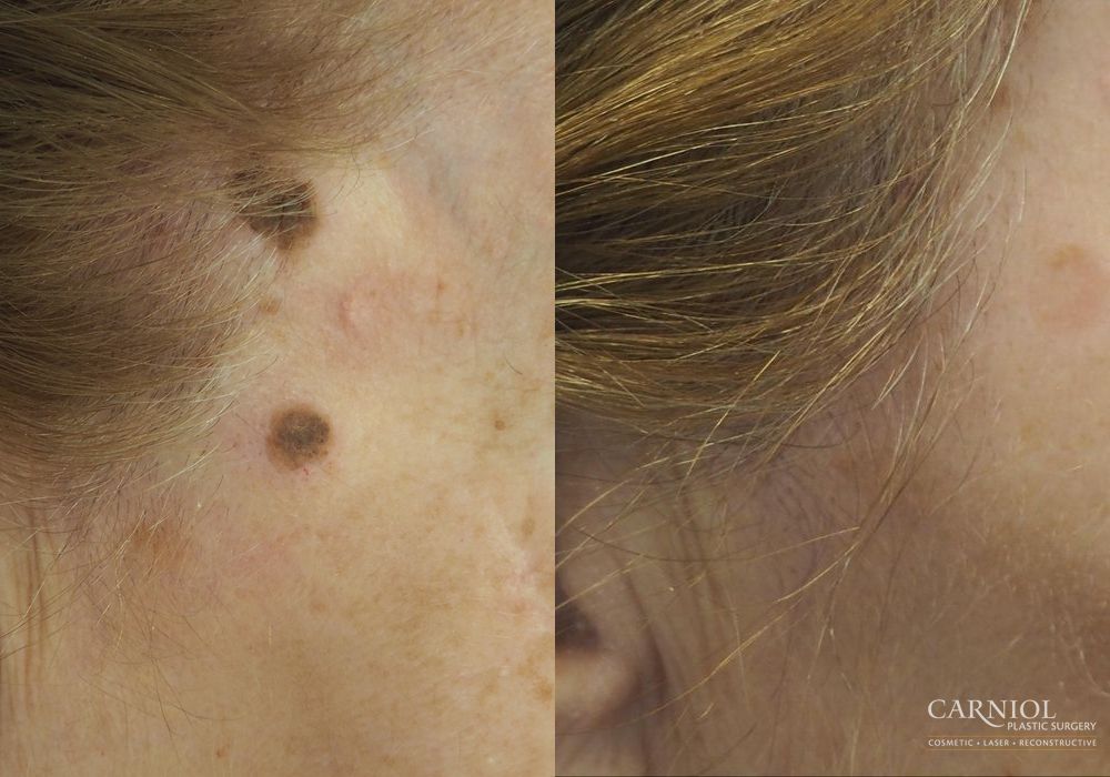 Before and after Mole or Age Spot Removal case 7715