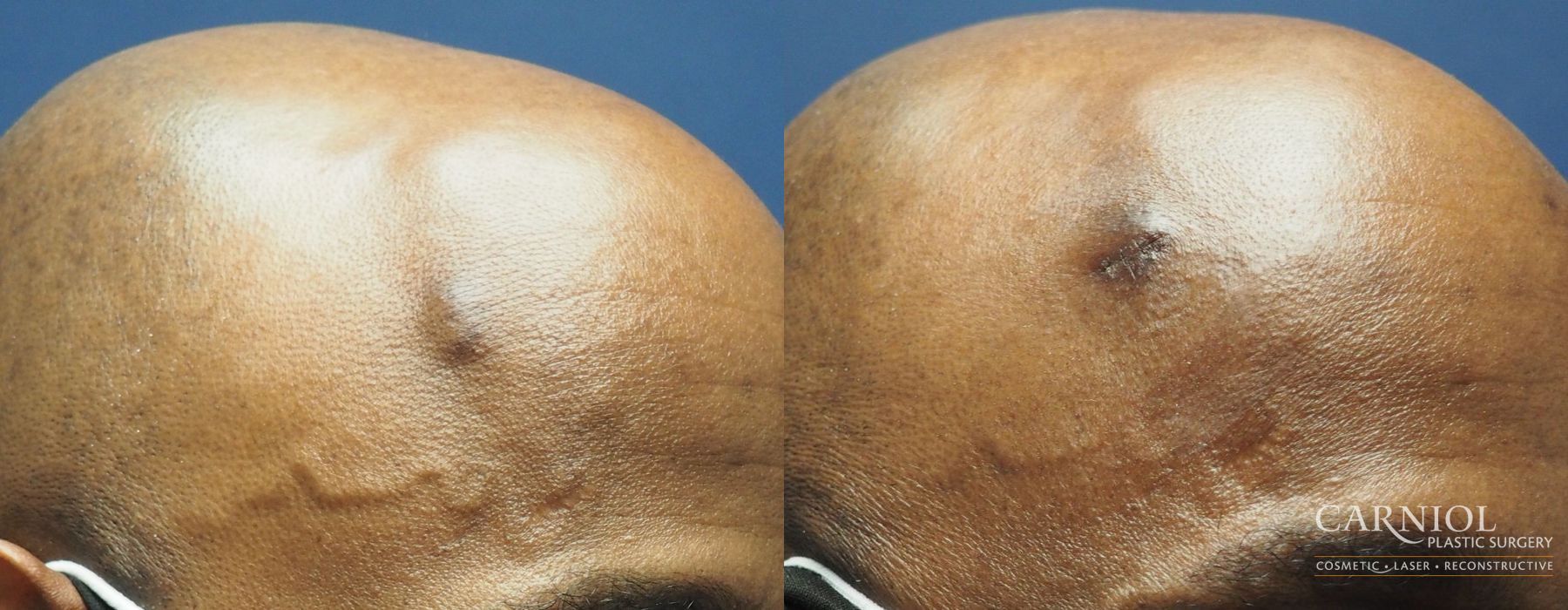 Mole or Age Spot Removal - Case 2810